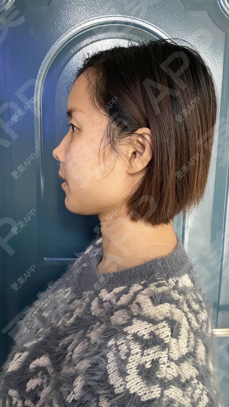 更美 - 更美用户tEad6dlAZq的凸嘴矫正经验 | 凸嘴矫正 | 武汉
