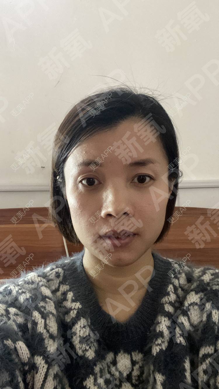 更美 - 更美用户tEad6dlAZq的凸嘴矫正经验 | 凸嘴矫正 | 武汉