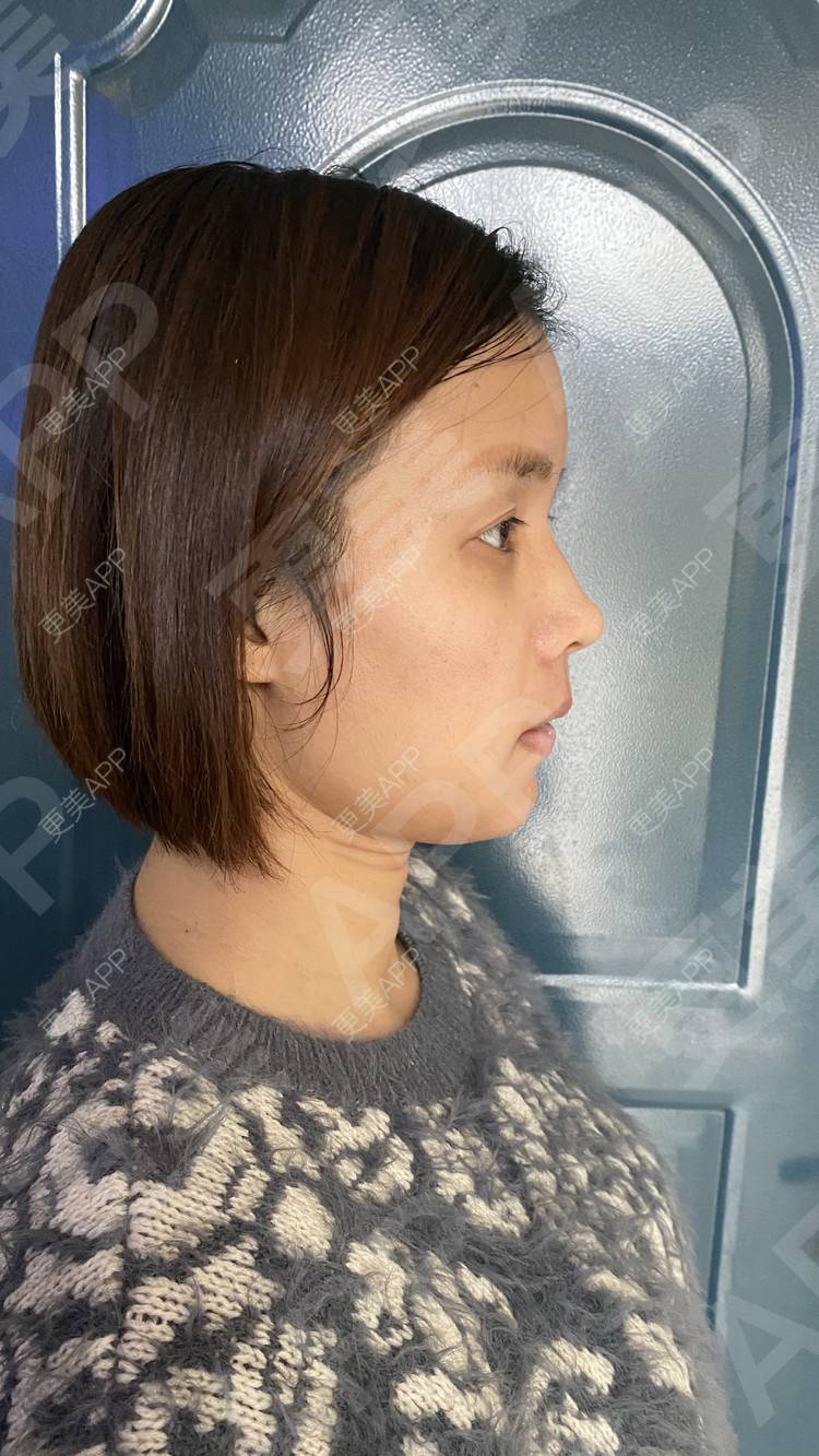 更美 - 更美用户tEad6dlAZq的凸嘴矫正经验 | 凸嘴矫正 | 武汉