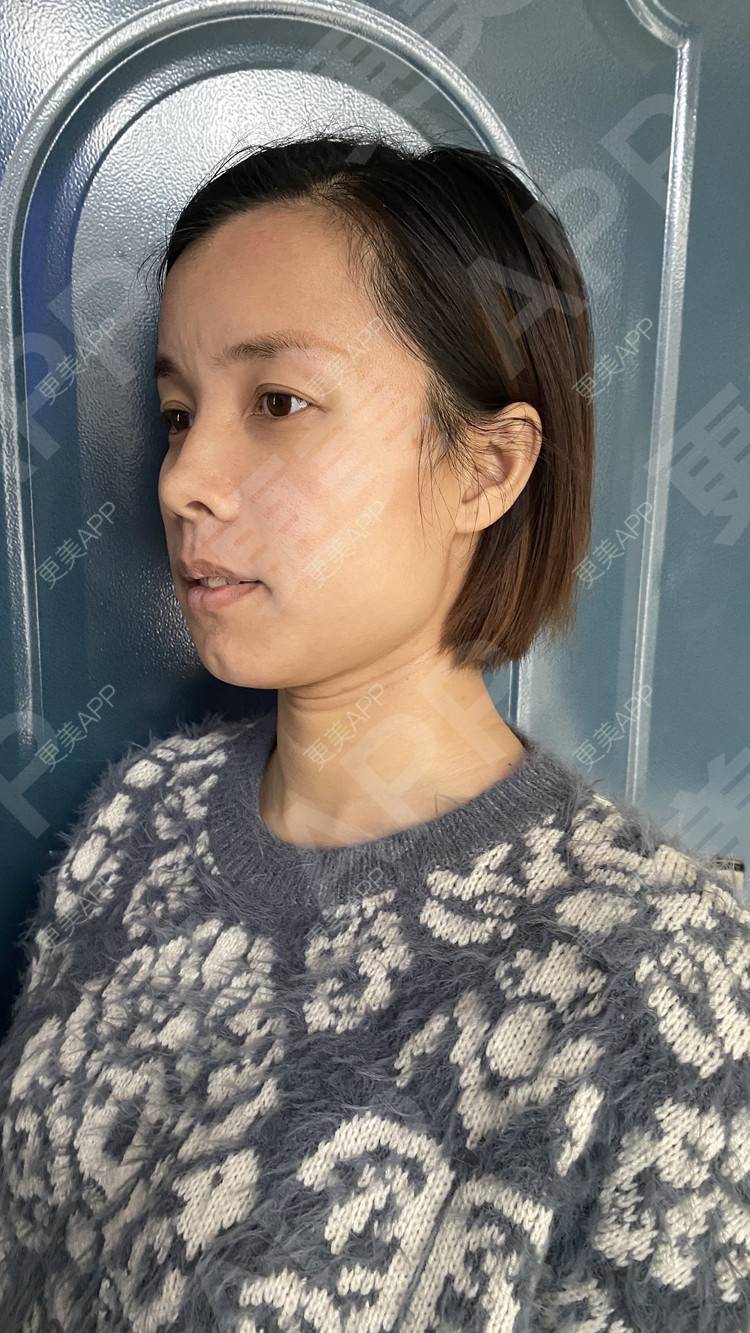 更美 - 更美用户tEad6dlAZq的凸嘴矫正经验 | 凸嘴矫正 | 武汉