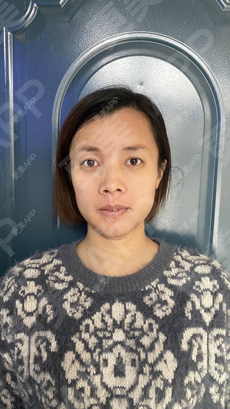 更美 - 更美用户tEad6dlAZq的凸嘴矫正经验 | 凸嘴矫正 | 武汉