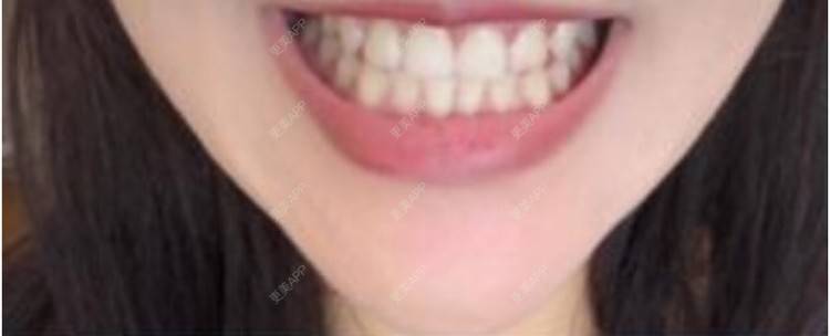 更美 - 更美用户OqajdS5nyJ的牙齿瓷贴面经验 | 广州 | 牙齿瓷贴面