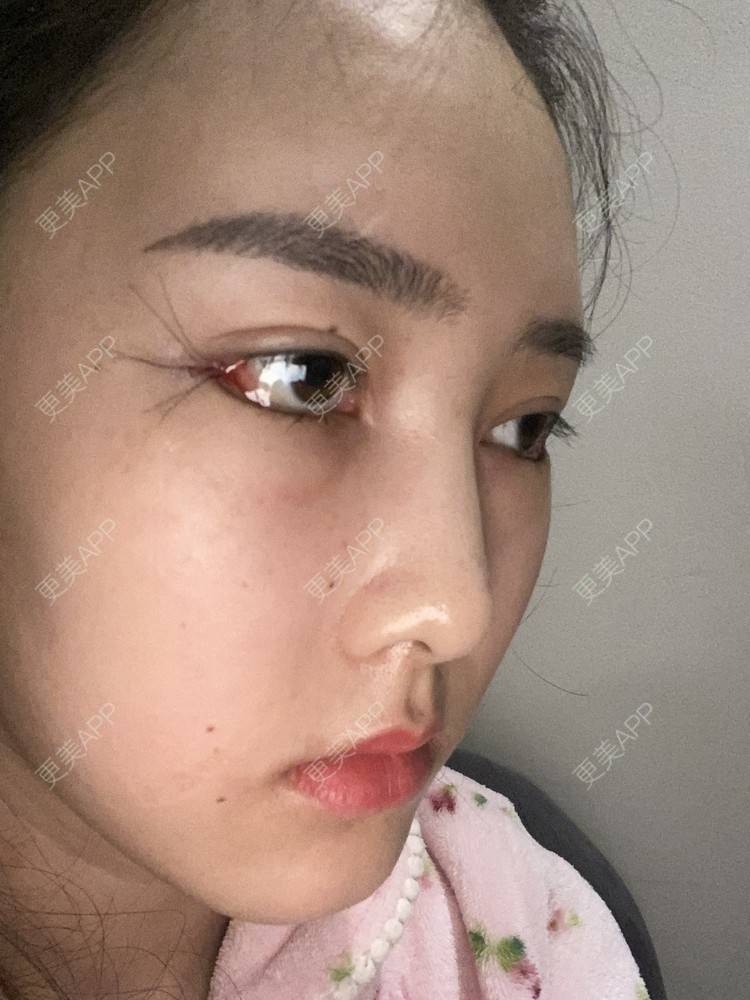 更美用户ijlqk7cyym的开内眼角日记