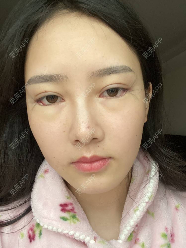 割双眼皮儿哪家医院好？医院的技术水准与否