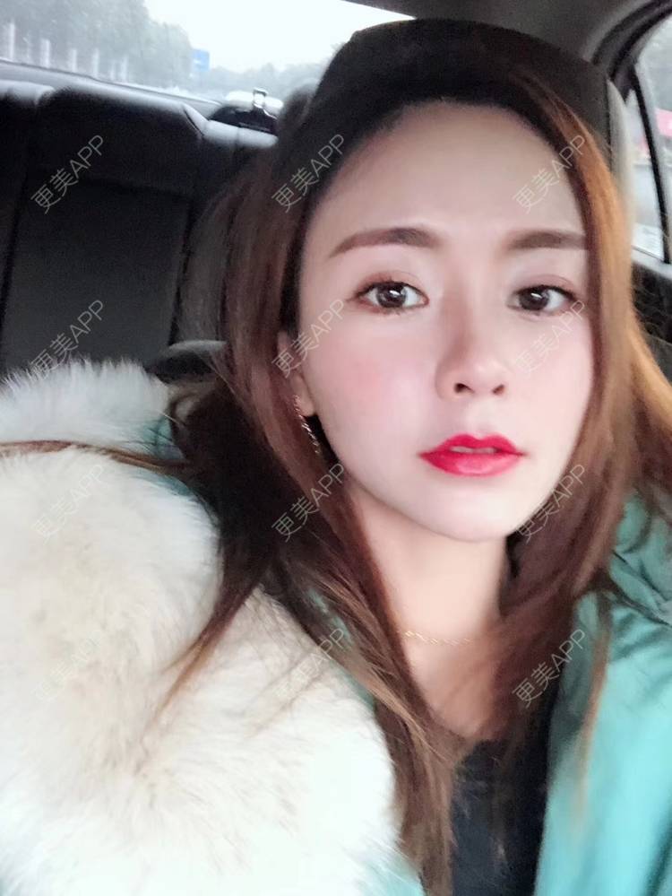 更美 - 坚持坚持坚持嗷的眼袋修复经验 | 眼综合修复 | 眼袋修复 | 重庆