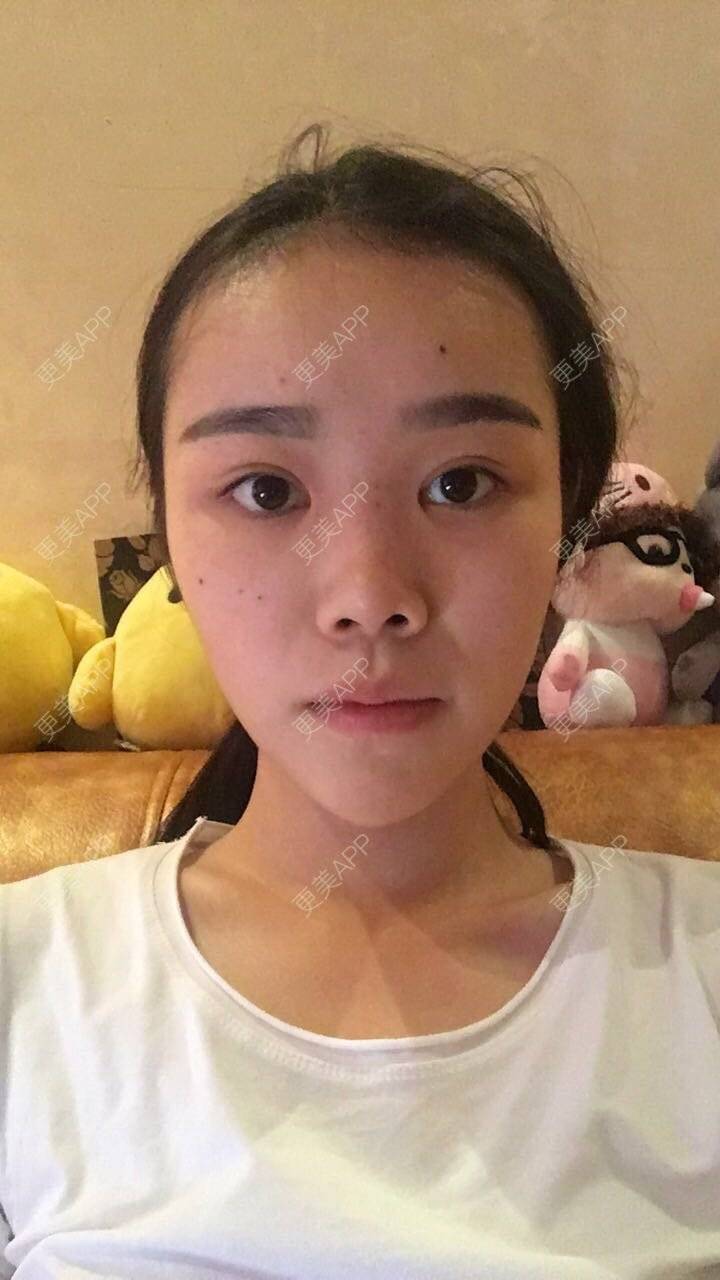 更美 - 鲁噜噜的经验 | 视频日记 | 隆鼻 | 重庆