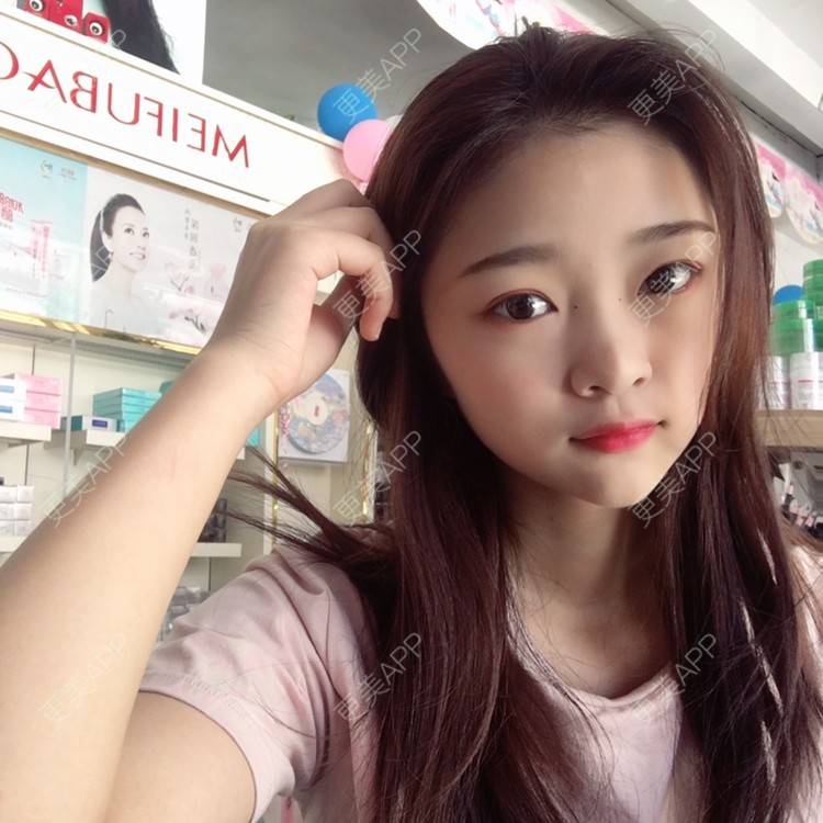 更美 - 更美用户VfaSXjhbLg的热玛吉经验 | 广州 | 热玛吉