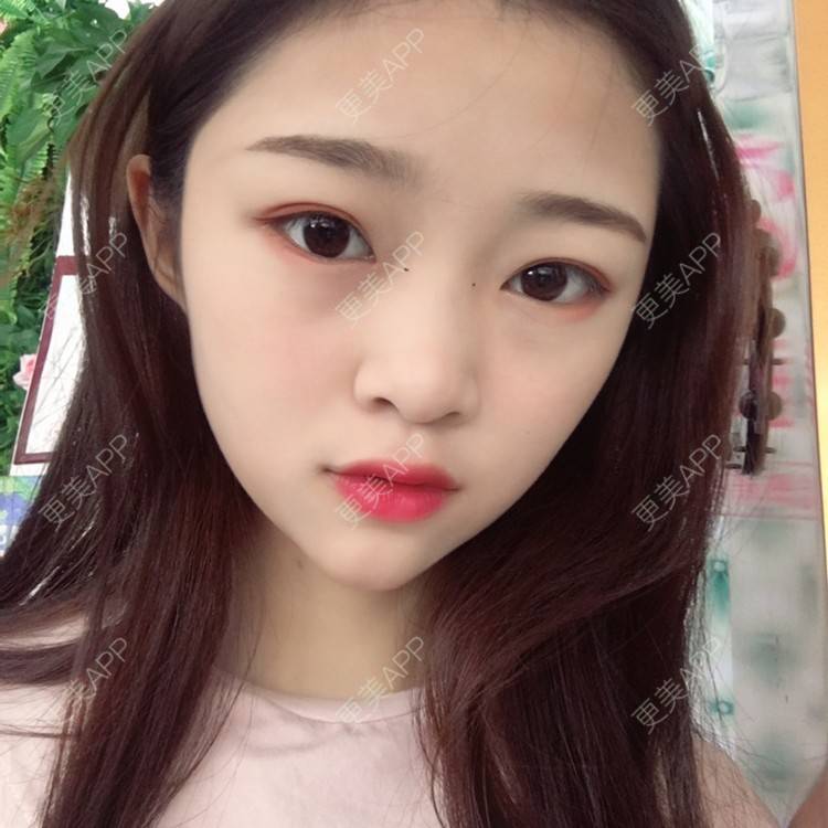 更美 - 更美用户VfaSXjhbLg的热玛吉经验 | 广州 | 热玛吉