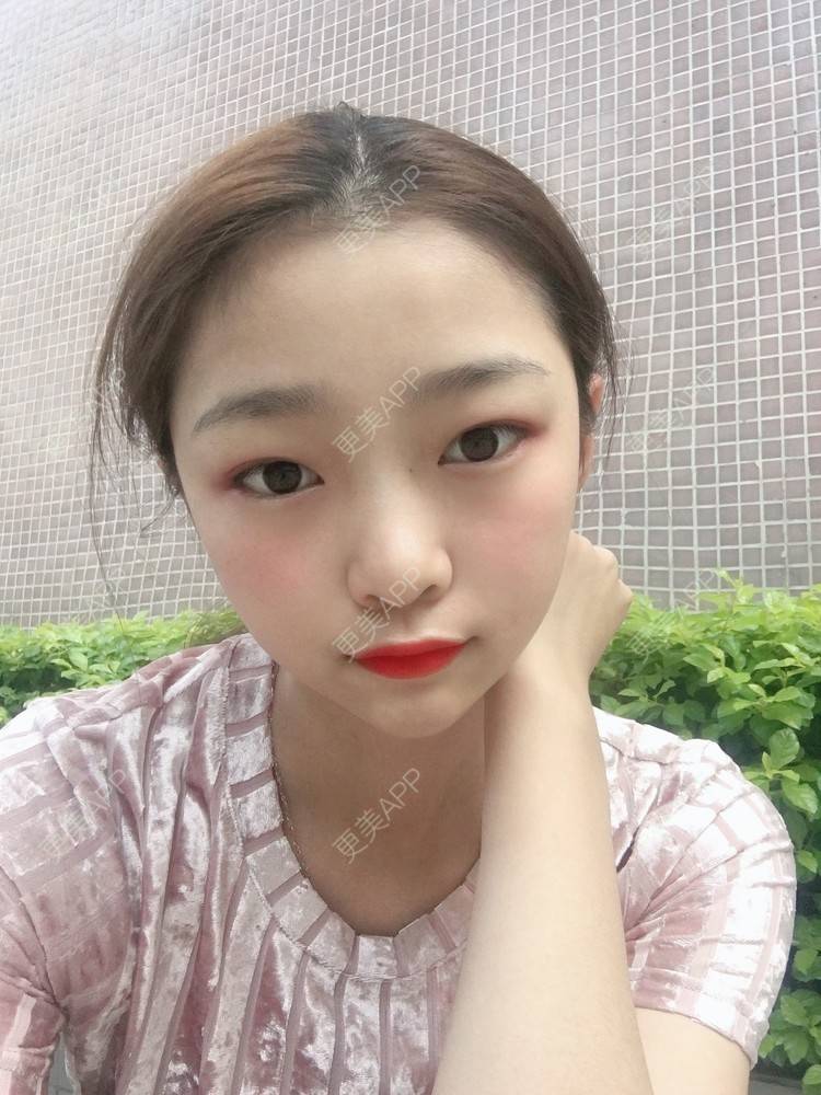 更美 - 更美用户VfaSXjhbLg的热玛吉经验 | 广州 | 热玛吉