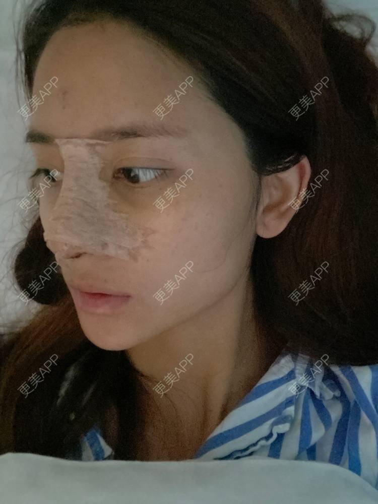 更美 - 小君君！的隆鼻经验 | 隆鼻 | 肋软骨隆鼻 | 鼻部多项 | 自体软骨垫鼻尖 | 鼻中隔软骨垫鼻头 | 重庆
