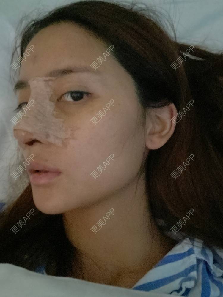 更美 - 小君君！的隆鼻经验 | 隆鼻 | 肋软骨隆鼻 | 鼻部多项 | 自体软骨垫鼻尖 | 鼻中隔软骨垫鼻头 | 重庆