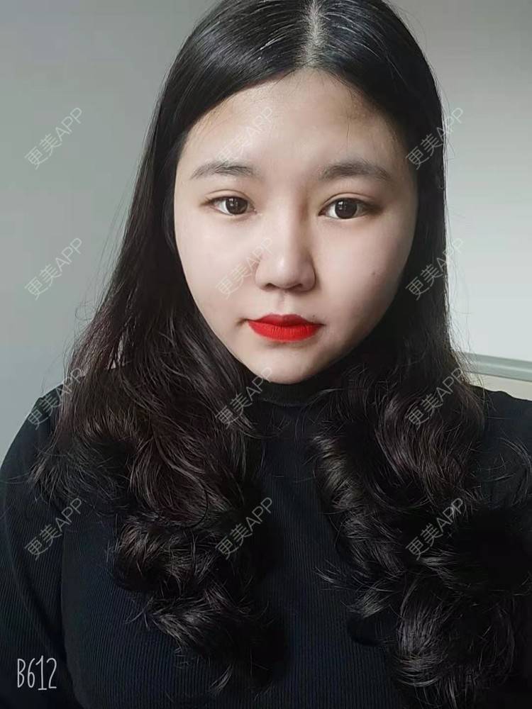 更美 - 你啊🎈的鼻部多项经验 | 鼻中隔软骨隆鼻 | 肋软骨隆鼻 | 鼻翼缩小 | 鼻小柱延长 | 鼻部多项 | 手术缩鼻头 | 自体软骨垫鼻尖 | 埋线隆鼻 | 鼻中隔软骨垫鼻头 | 注射缩鼻头 | 耳软骨隆鼻 | 鼻小柱缩短