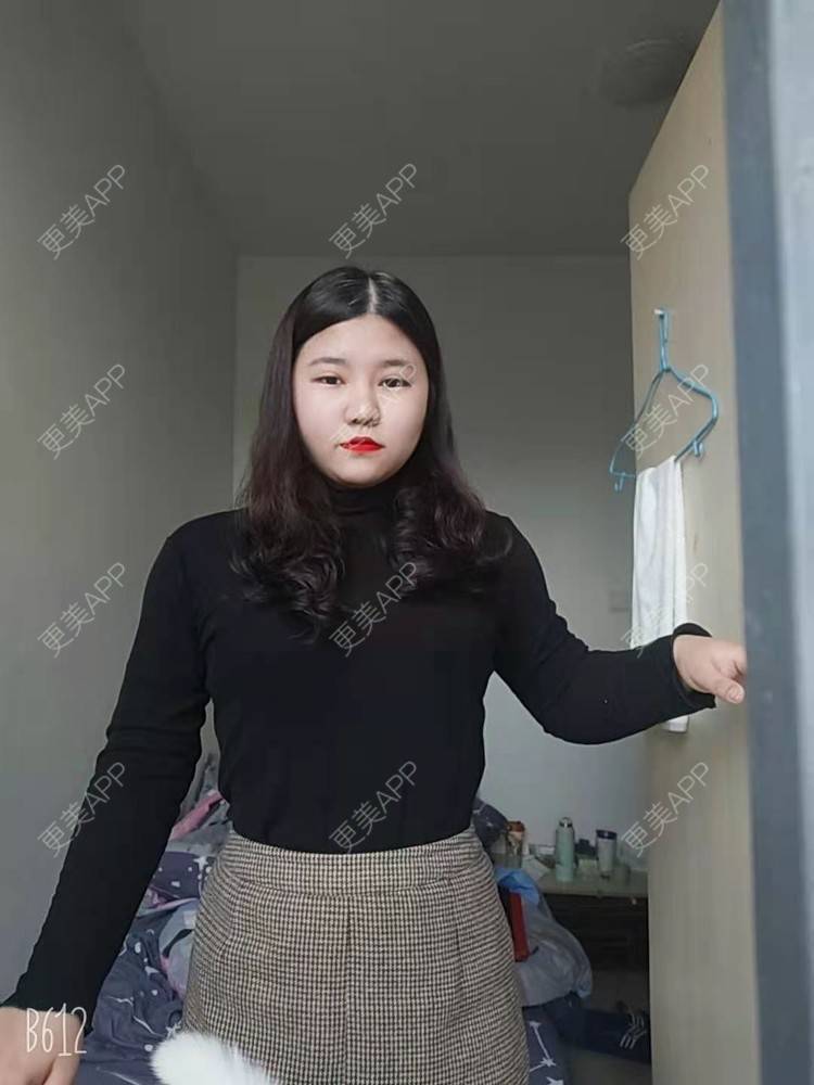 更美 - 你啊🎈的鼻部多项经验 | 鼻中隔软骨隆鼻 | 肋软骨隆鼻 | 鼻翼缩小 | 鼻小柱延长 | 鼻部多项 | 手术缩鼻头 | 自体软骨垫鼻尖 | 埋线隆鼻 | 鼻中隔软骨垫鼻头 | 注射缩鼻头 | 耳软骨隆鼻 | 鼻小柱缩短