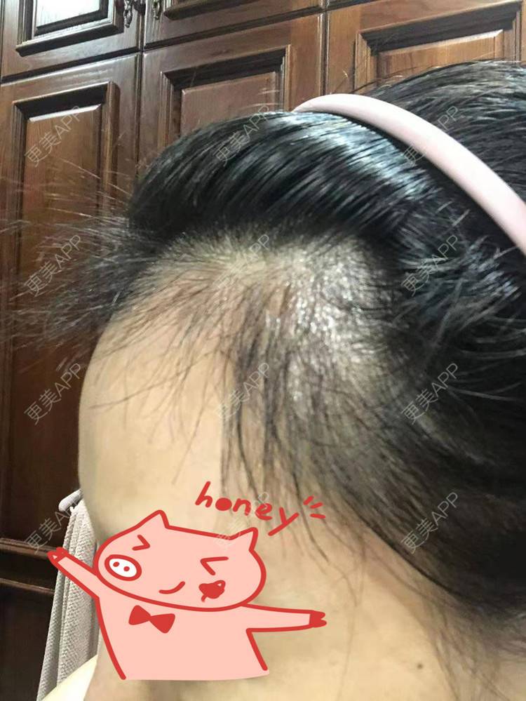 更美 - ★傻蛋╮绷的植发际线经验 | 植发际线 | 长沙