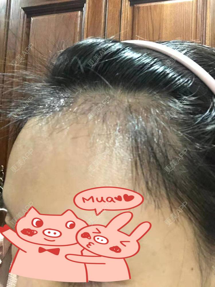 更美 - ★傻蛋╮绷的植发际线经验 | 植发际线 | 长沙