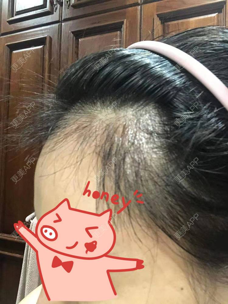 更美 - ★傻蛋╮绷的植发际线经验 | 植发际线 | 长沙