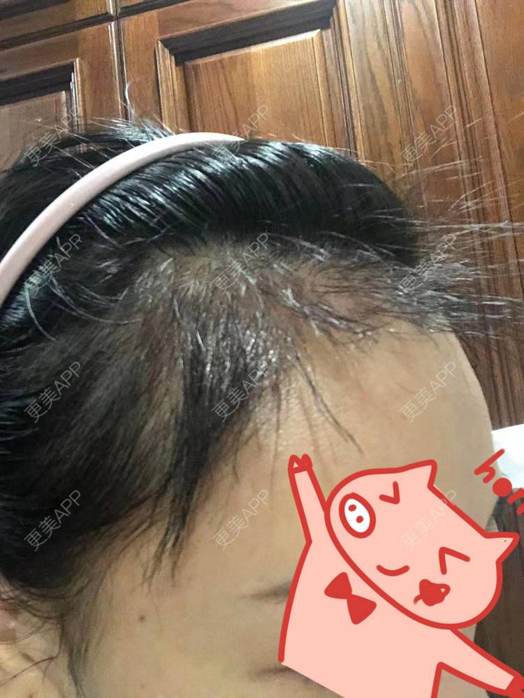 更美 - ★傻蛋╮绷的植发际线经验 | 植发际线 | 长沙