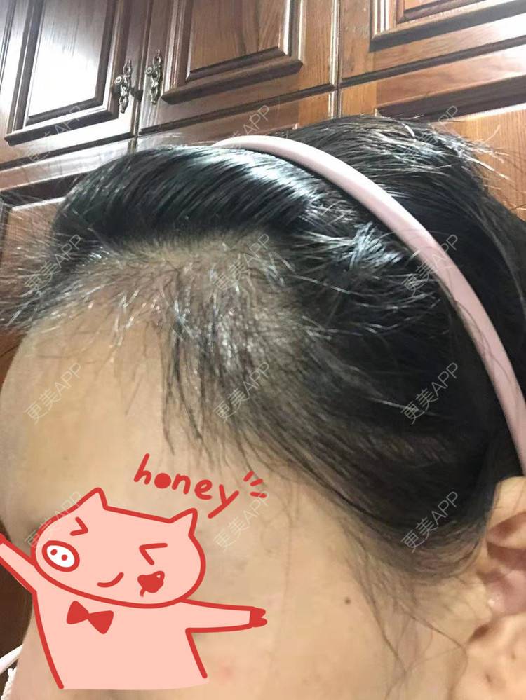 更美 - ★傻蛋╮绷的植发际线经验 | 植发际线 | 长沙