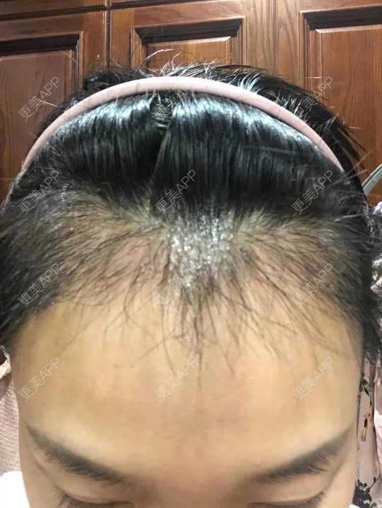 更美 - ★傻蛋╮绷的植发际线经验 | 植发际线 | 长沙