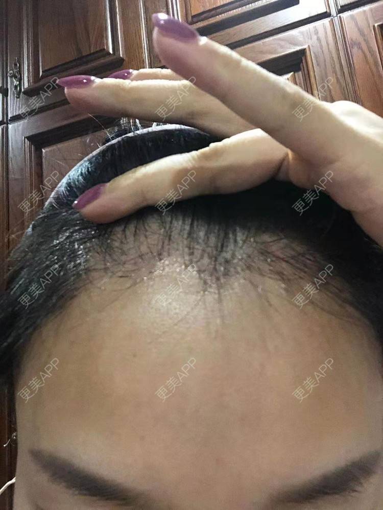 更美 - ★傻蛋╮绷的植发际线经验 | 植发际线 | 长沙