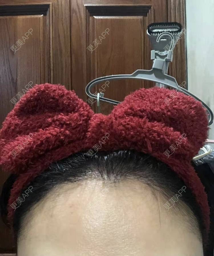 更美 - ★傻蛋╮绷的植发际线经验 | 植发际线 | 长沙