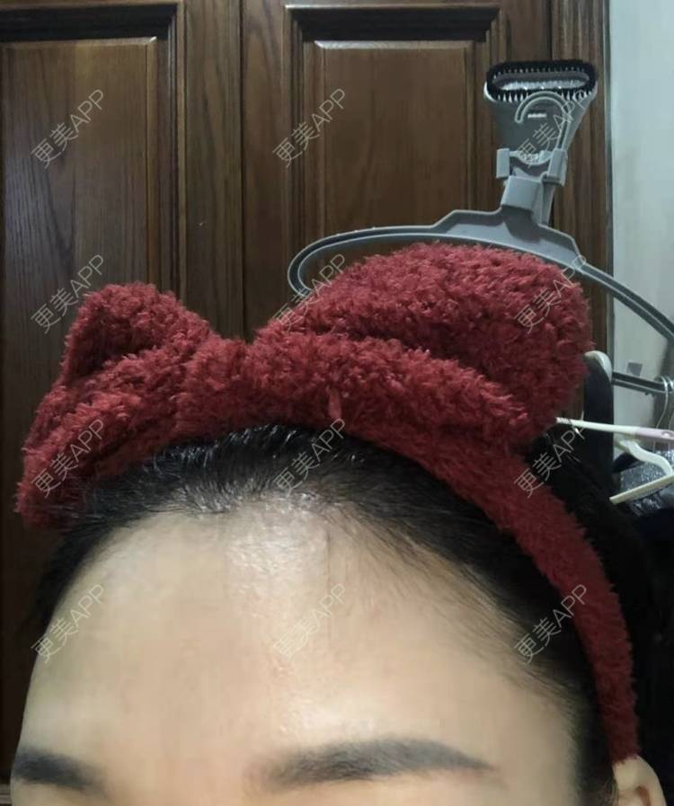 更美 - ★傻蛋╮绷的植发际线经验 | 植发际线 | 长沙