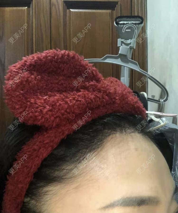 更美 - ★傻蛋╮绷的植发际线经验 | 植发际线 | 长沙