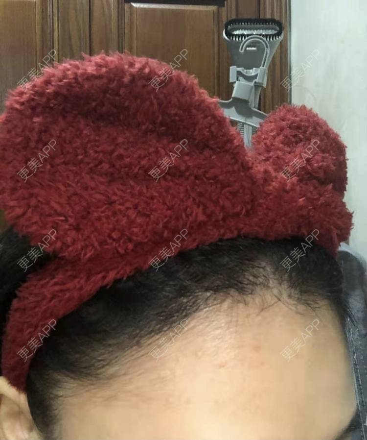 更美 - ★傻蛋╮绷的植发际线经验 | 植发际线 | 长沙