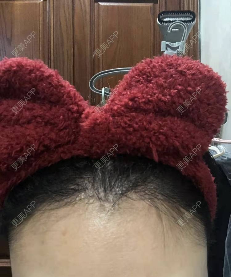 更美 - ★傻蛋╮绷的植发际线经验 | 植发际线 | 长沙