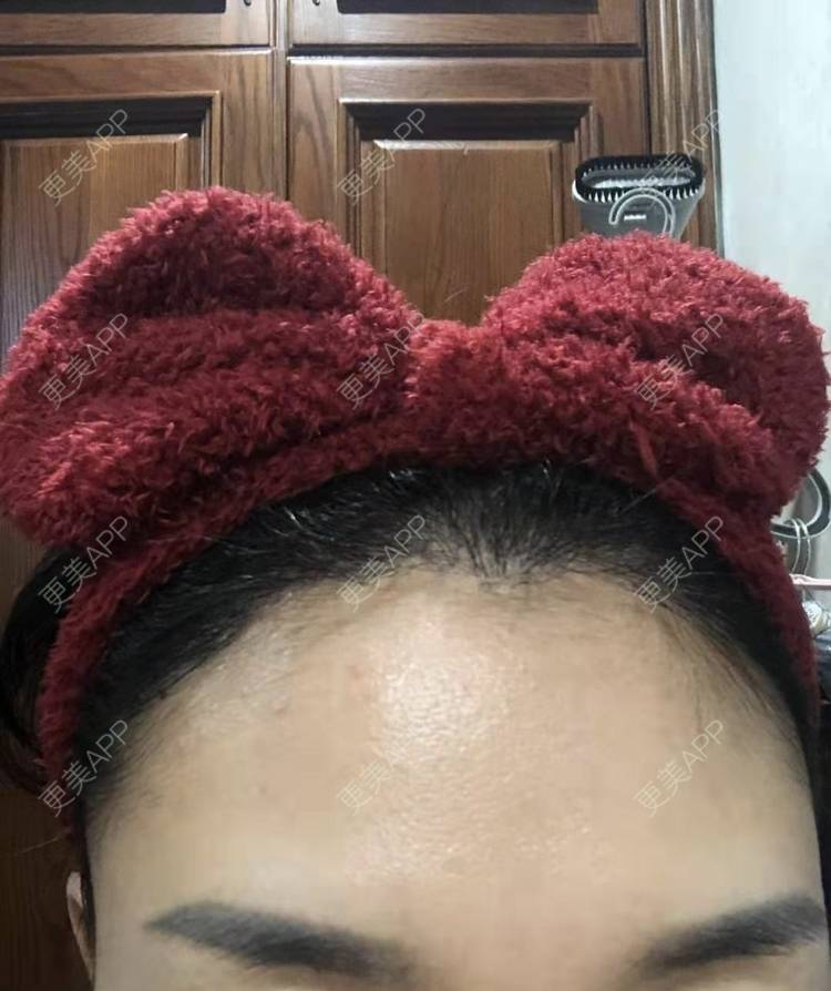 更美 - ★傻蛋╮绷的植发际线经验 | 植发际线 | 长沙