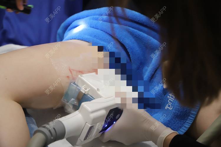 更美 - 更美用户B6fEZfgkWU的冷冻减脂瘦大腿经验 | 冷冻溶脂 | 冷冻减脂瘦大腿