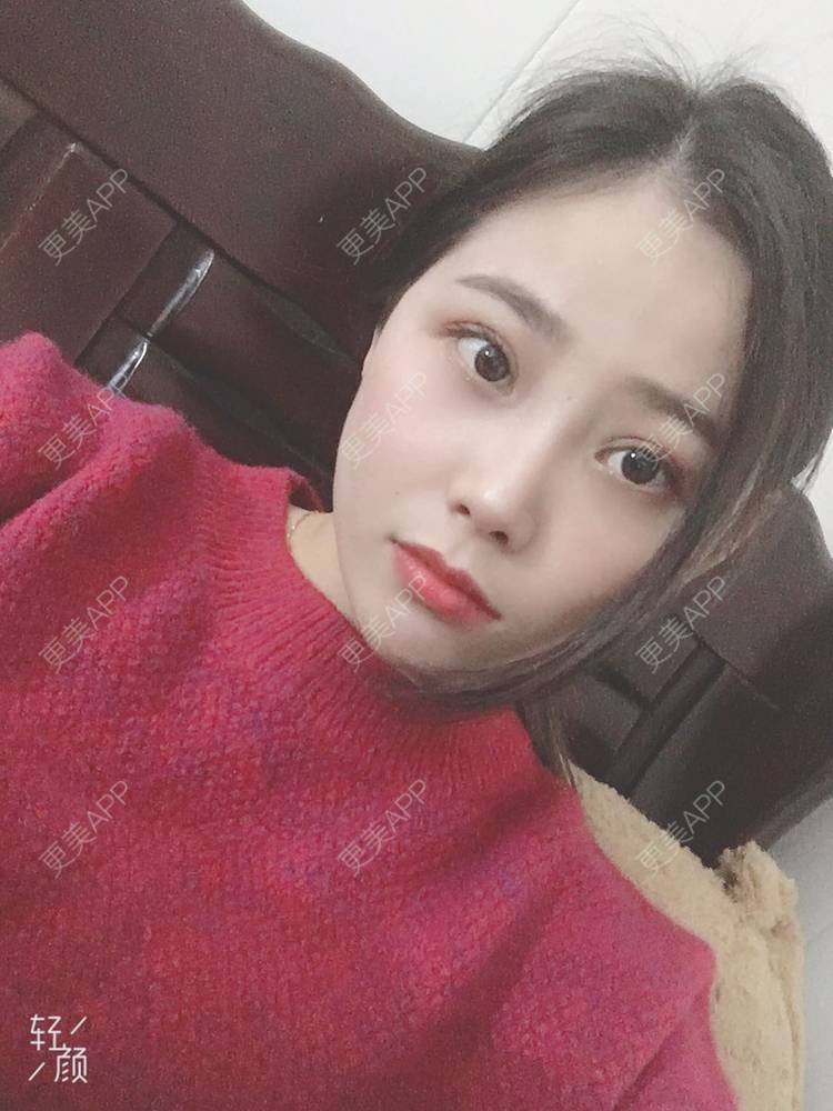 更美 - 今夜沉眠如凉的双眼皮经验 | 广州 | 双眼皮