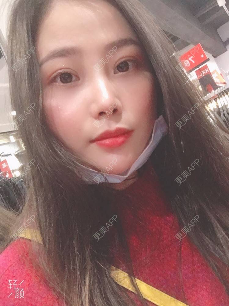 更美 - 今夜沉眠如凉的双眼皮经验 | 广州 | 双眼皮