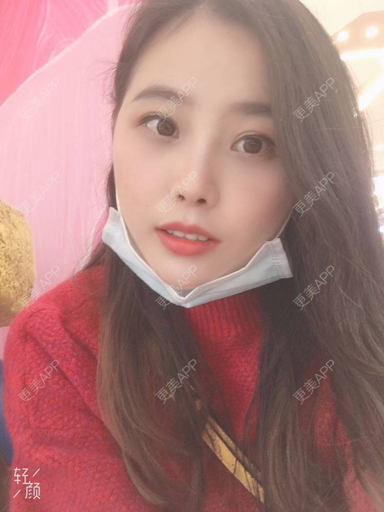 更美 - 今夜沉眠如凉的双眼皮经验 | 广州 | 双眼皮
