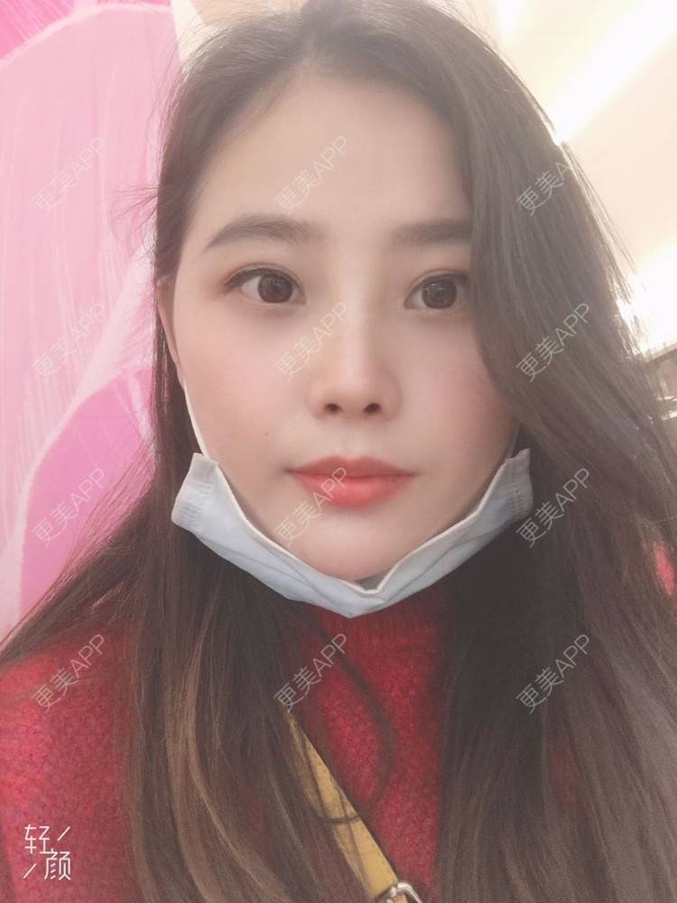 更美 - 今夜沉眠如凉的双眼皮经验 | 广州 | 双眼皮