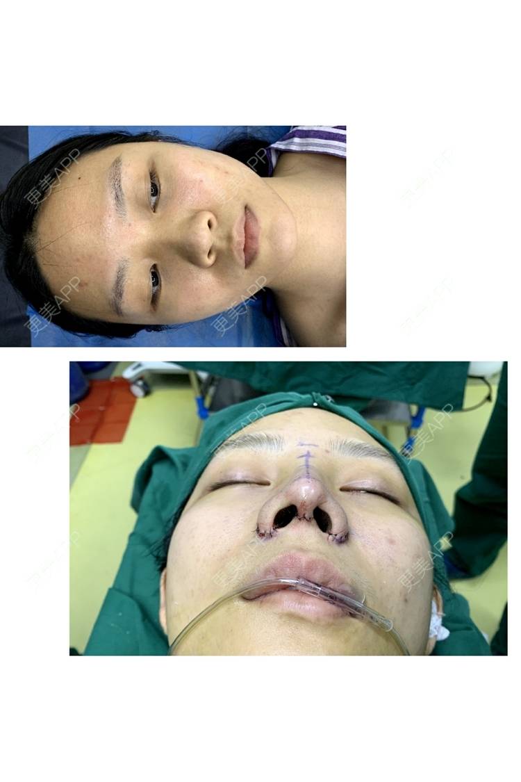 更美 - 肉嘟嘟儿的鼻部多项经验 | 杭州 | 鼻部多项