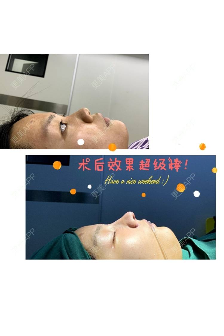 更美 - 肉嘟嘟儿的鼻部多项经验 | 杭州 | 鼻部多项