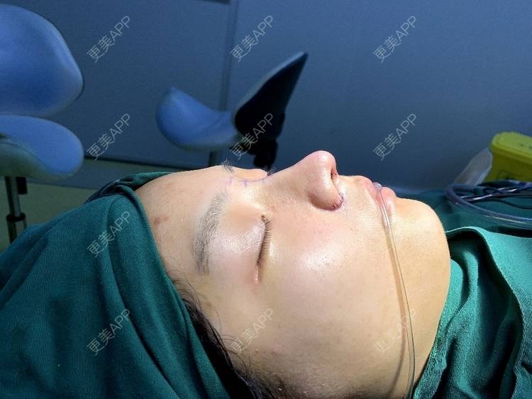 更美 - 肉嘟嘟儿的鼻部多项经验 | 杭州 | 鼻部多项