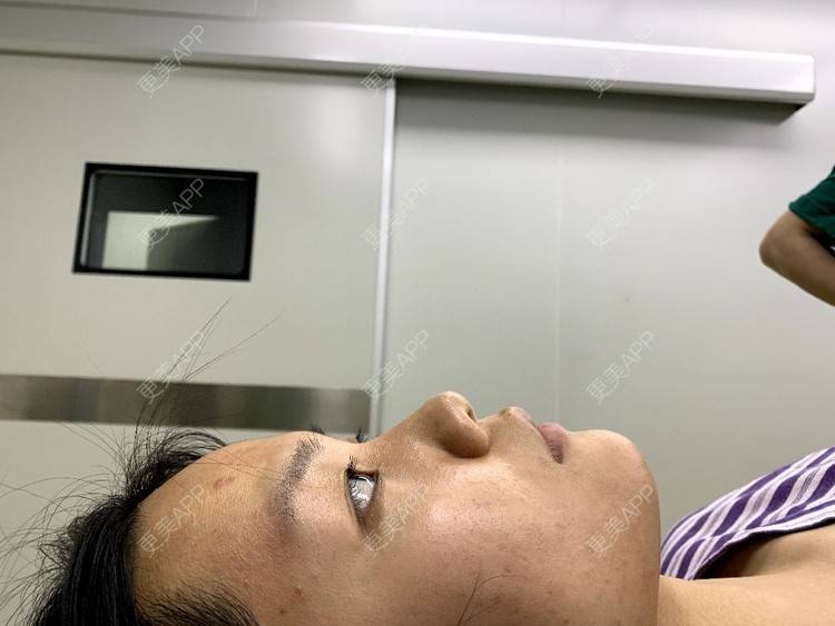 更美 - 肉嘟嘟儿的鼻部多项经验 | 杭州 | 鼻部多项