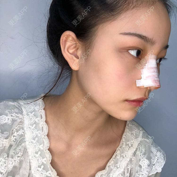 更美 - 给我个桃的鼻部多项经验 | 杭州 | 鼻部多项