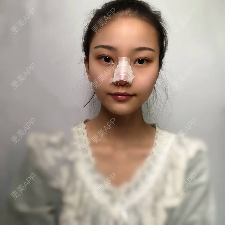 更美 - 给我个桃的鼻部多项经验 | 杭州 | 鼻部多项
