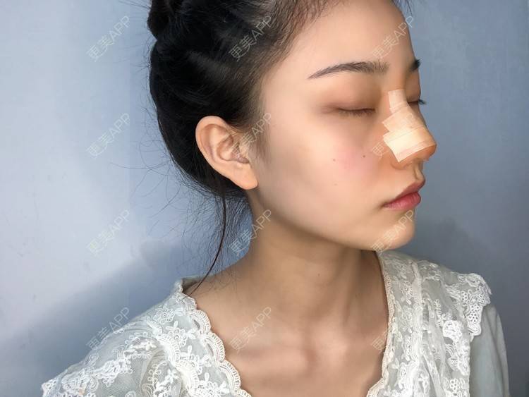更美 - 给我个桃的鼻部多项经验 | 杭州 | 鼻部多项