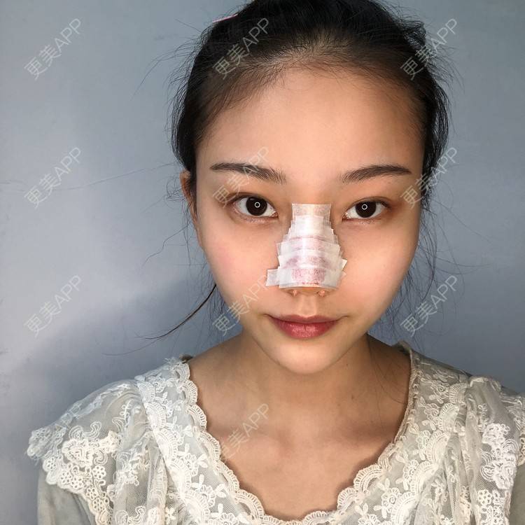 更美 - 给我个桃的鼻部多项经验 | 杭州 | 鼻部多项