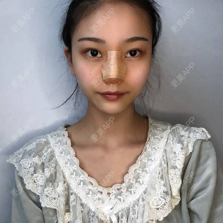 更美 - 给我个桃的鼻部多项经验 | 杭州 | 鼻部多项