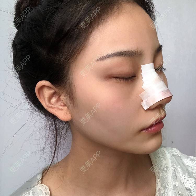 更美 - 给我个桃的鼻部多项经验 | 杭州 | 鼻部多项