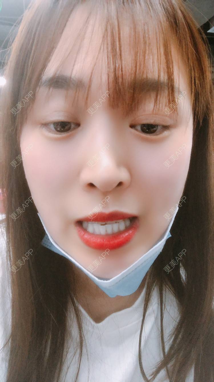 更美 - 更美用户nOSa2OXrxm的冷光美白经验 | 北京 | 冷光美白