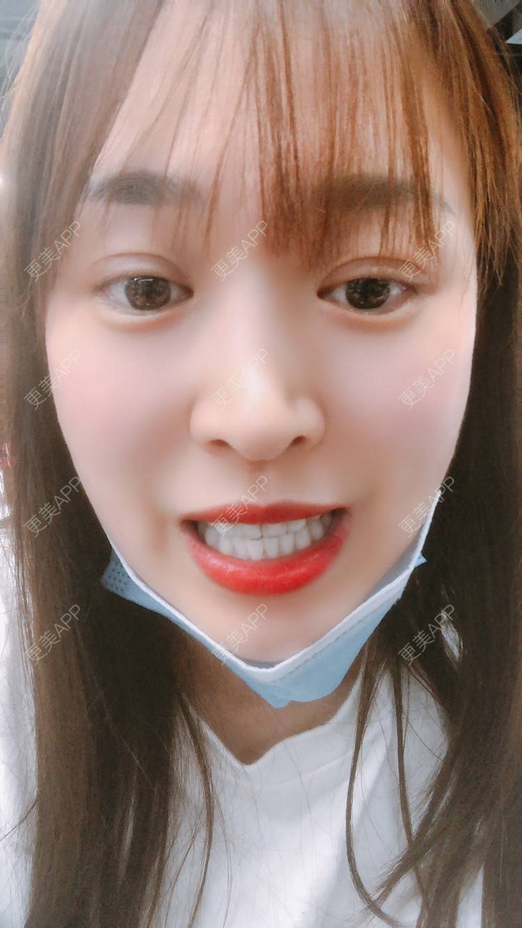更美 - 更美用户nOSa2OXrxm的冷光美白经验 | 北京 | 冷光美白