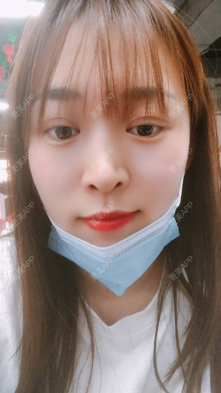 更美 - 更美用户nOSa2OXrxm的冷光美白经验 | 北京 | 冷光美白