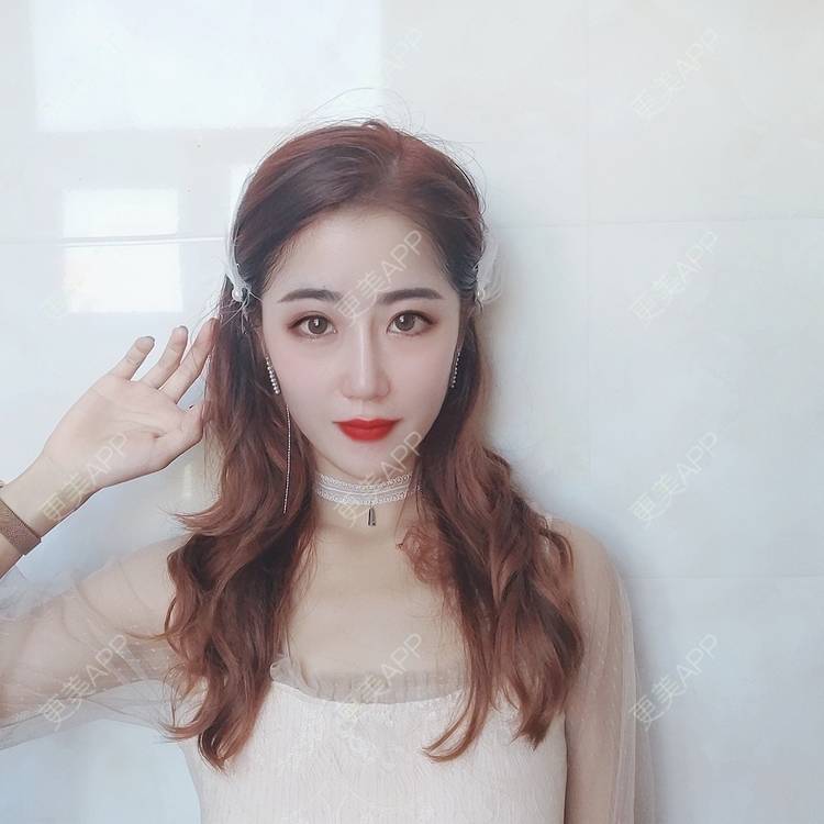 更美 - 王亚花的硅胶丰太阳穴经验 | 郑州 | 硅胶丰太阳穴 | 视频日记