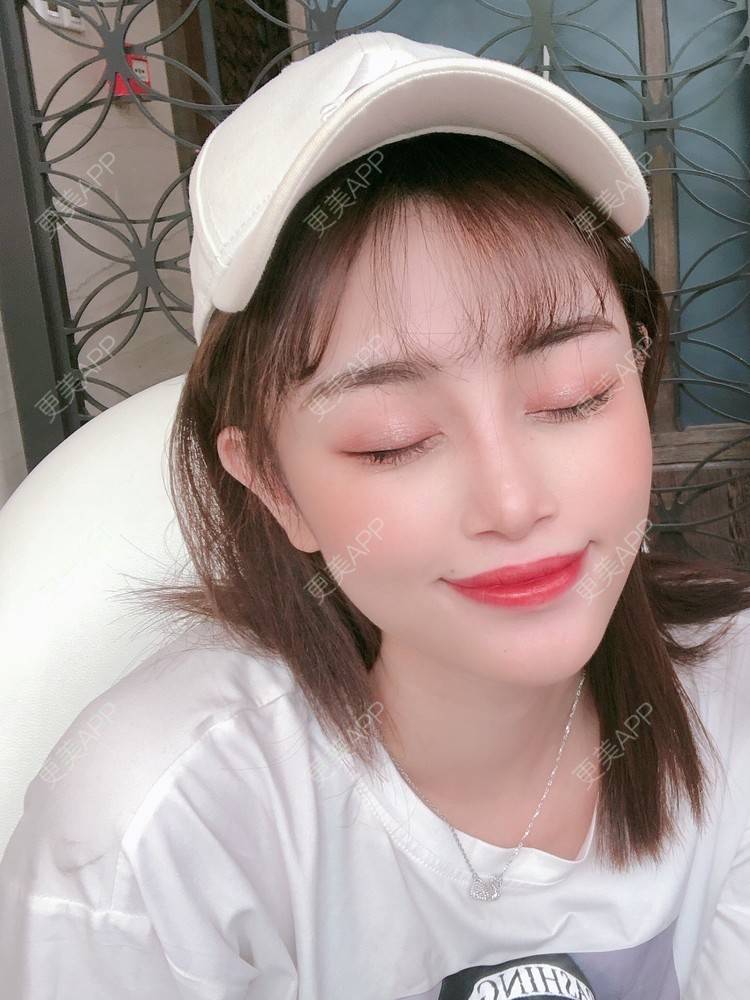 更美 - 更美用户1x72xdARbX的玻尿酸太阳穴经验 | 玻尿酸太阳穴 | 玻尿酸鼻基底 | 武汉
